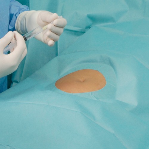 Foliodrape fenestrated surgical dra